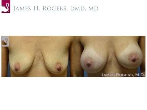 Breast Augmentation Case #53445 (Image 1)