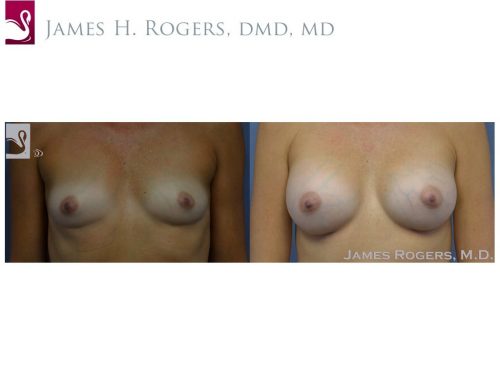 Breast Augmentation Case #54028 (Image 1)