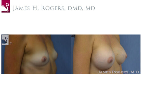 Breast Augmentation Case #54028 (Image 2)