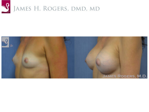 Breast Augmentation Case #54028 (Image 3)