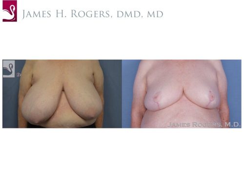 Female Breast Reduction Case #54633 (Image 1)