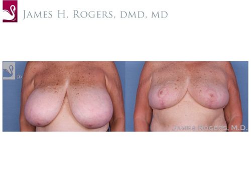 Female Breast Reduction Case #56225 (Image 1)