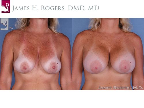 Breast Augmentation Case #12225 (Image 1)