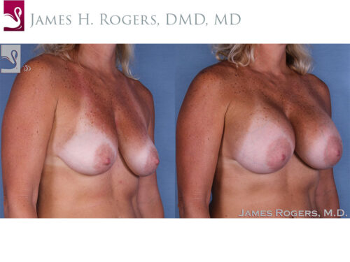 Breast Augmentation Case #12225 (Image 2)