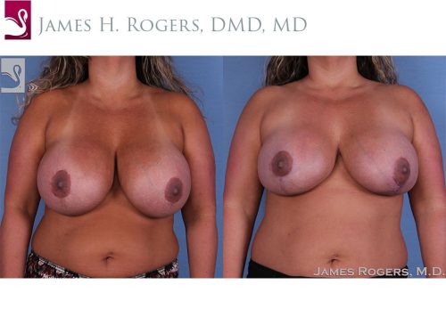 Breast Revisions Case #27846 (Image 1)