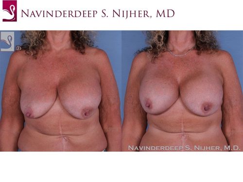 Breast Revisions Case #35717 (Image 1)