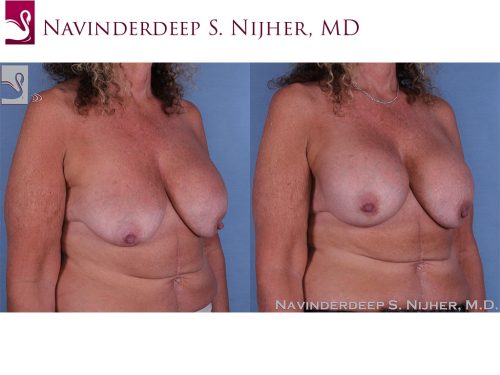 Breast Revisions Case #35717 (Image 2)