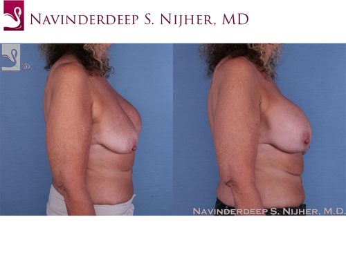 Breast Revisions Case #35717 (Image 3)