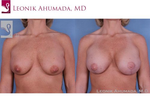 Breast Revisions Case #37955 (Image 1)