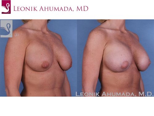 Breast Revisions Case #37955 (Image 2)