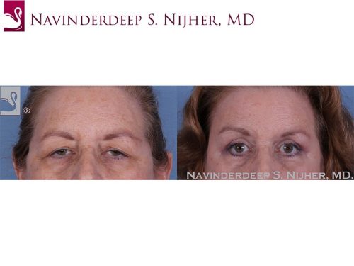 Eyelid Surgery Case #49304 (Image 1)