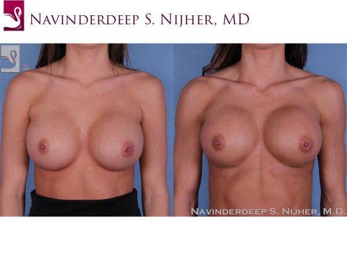 Breast Revisions Case #54398 (Image 1)