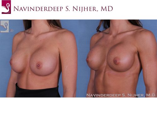 Breast Revisions Case #54398 (Image 2)