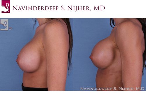 Breast Revisions Case #54398 (Image 3)