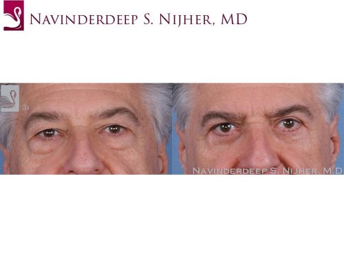 Eyelid Surgery Case #56880 (Image 1)