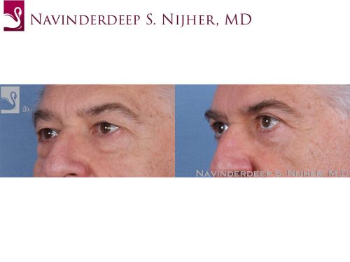 Eyelid Surgery Case #56880 (Image 2)