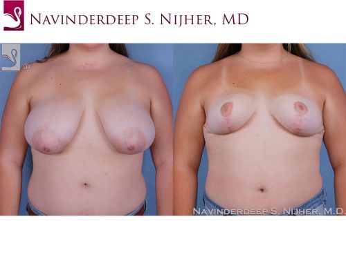 Female Breast Reduction Case #59113 (Image 1)