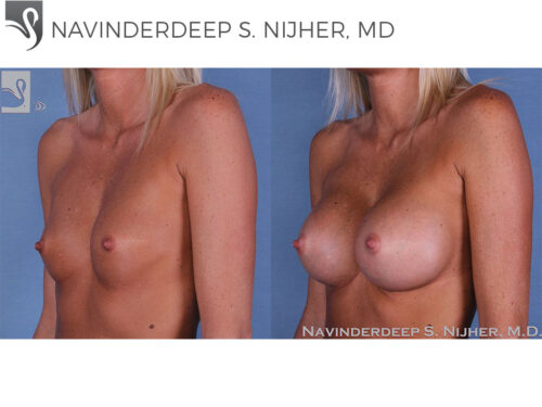 Breast Augmentation Case #59727 (Image 2)
