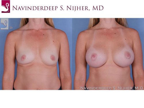 Breast Augmentation Case #60160 (Image 1)