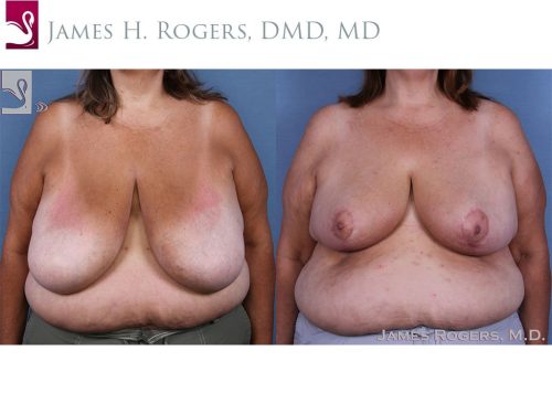 Female Breast Reduction Case #58784 (Image 1)