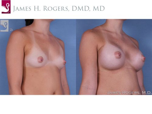 Breast Augmentation Case #58799 (Image 2)