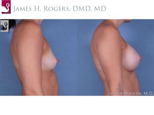 Breast Augmentation Case #58799 (Image 3)