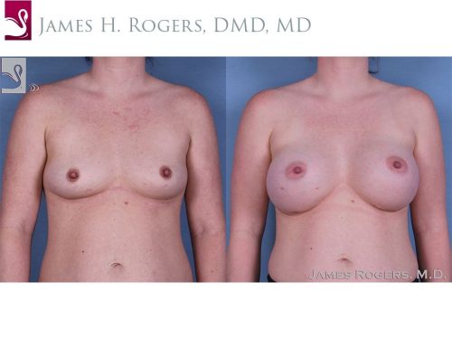 Breast Augmentation Case #58823 (Image 1)