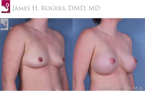 Breast Augmentation Case #58823 (Image 2)