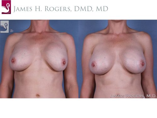 Breast Revisions Case #41484 (Image 1)