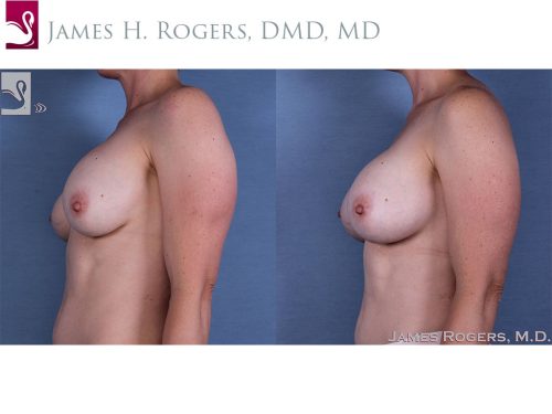 Breast Revisions Case #41484 (Image 3)