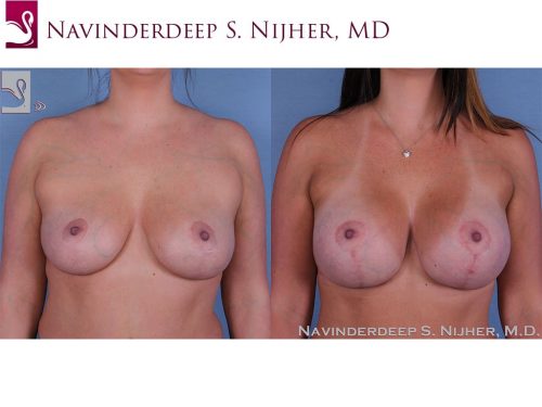 Breast Augmentation with Mastopexy (Breast Lift) Case #44752 (Image 1)