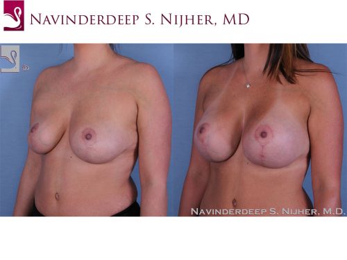 Breast Augmentation with Mastopexy (Breast Lift) Case #44752 (Image 2)