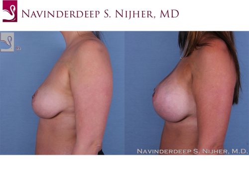Breast Augmentation with Mastopexy (Breast Lift) Case #44752 (Image 3)