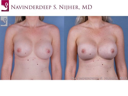 Breast Revisions Case #58214 (Image 1)