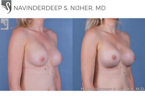 Breast Revisions Case #58214 (Image 2)