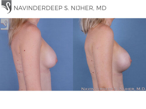 Breast Revisions Case #58214 (Image 3)