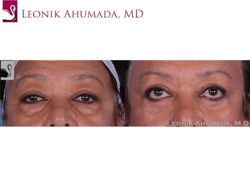 Before and after image of a real plastic surgery procedure performed by Dr. Ahumada.