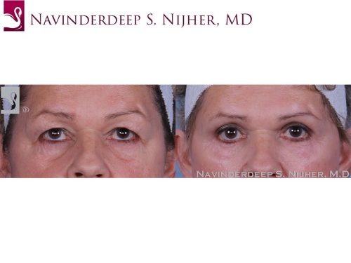Eyelid Surgery Case #59409 (Image 1)