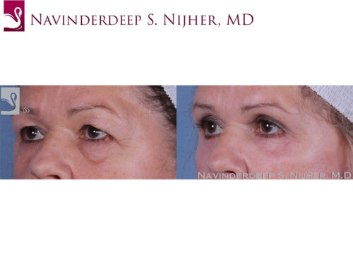 Eyelid Surgery Case #59409 (Image 2)