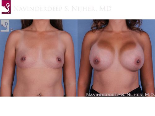 Breast Augmentation Case #59812 (Image 1)