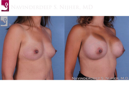 Breast Augmentation Case #59812 (Image 2)