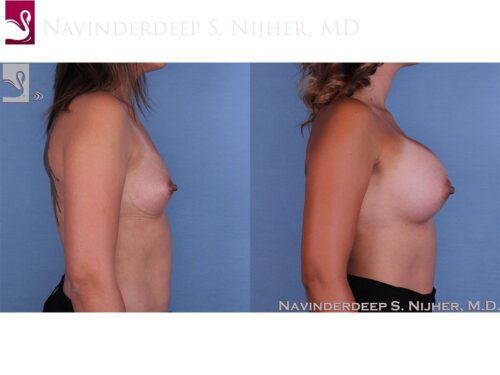 Breast Augmentation Case #59812 (Image 3)