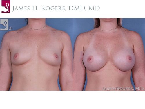 Breast Augmentation Case #60414 (Image 1)