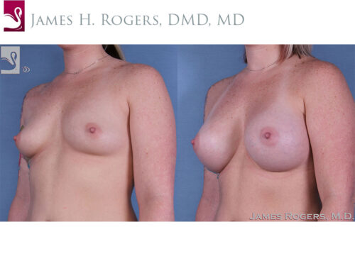 Breast Augmentation Case #60414 (Image 2)