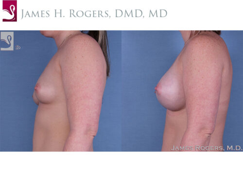 Breast Augmentation Case #60414 (Image 3)