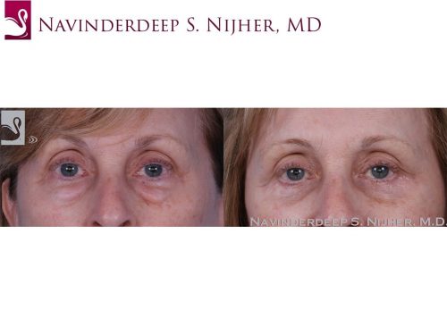 Eyelid Surgery Case #61075 (Image 1)