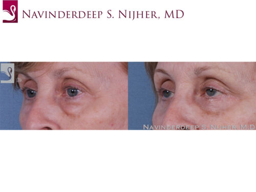 Eyelid Surgery Case #61075 (Image 2)