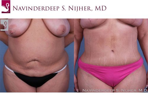 Before and after image of a real plastic surgery procedure performed by Dr. Nijher.