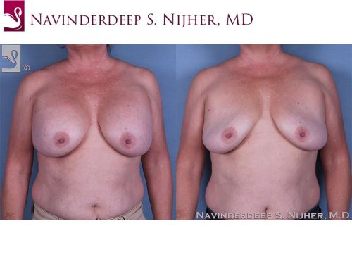 Breast Revisions Case #60683 (Image 1)