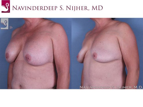 Breast Revisions Case #60683 (Image 2)